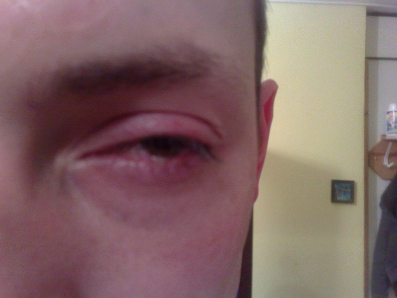 Kyselina sýrová vs moje oko